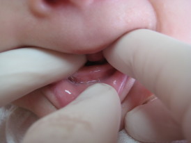 dente nascendo